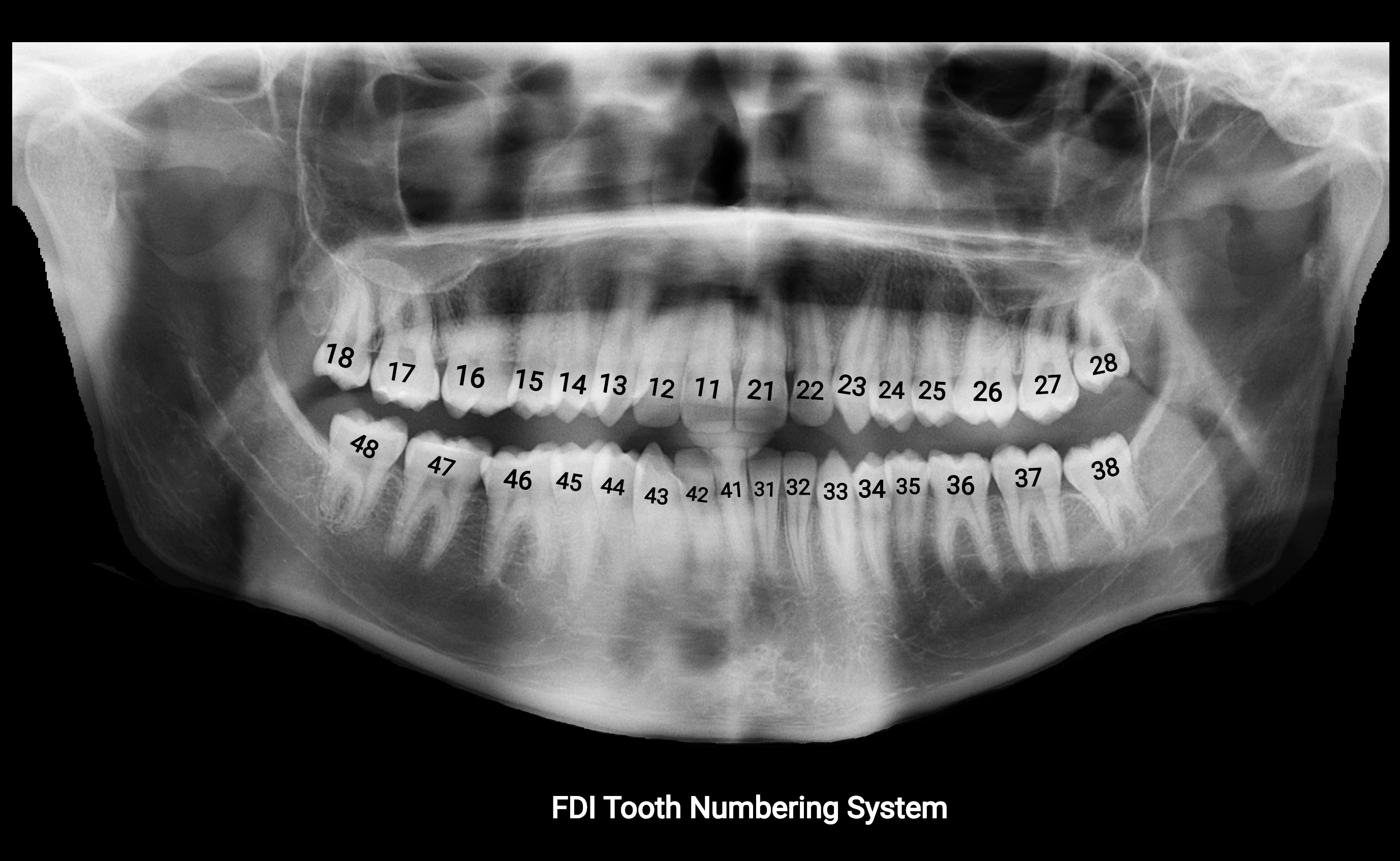 Orthopantomogram (OPG) X Ray anatomy labelled image 3.webp